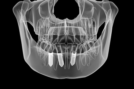 implantes dentales clínica dental Madrid