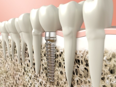 implante dental Madrid