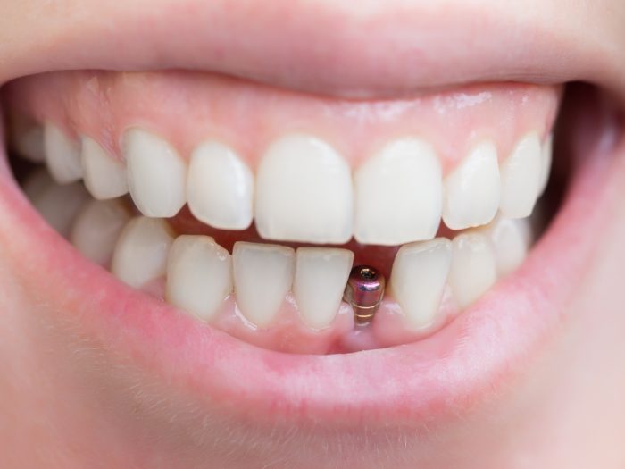 clínica dental en Madrid centro