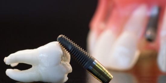 implantes dentales clínicas Madrid