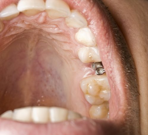 implantes dentales all on Four Madrid