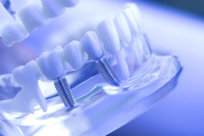 implantes dentales en Madrid