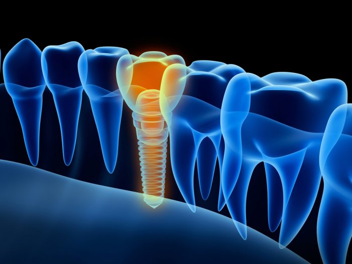 implantes por ordenador Madrid