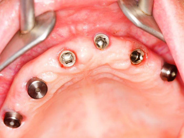 micro-implantes dentales Madrid